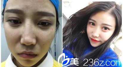 德州友誼醫(yī)院面部提升案例分享