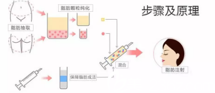 自體脂肪填充私密示意圖