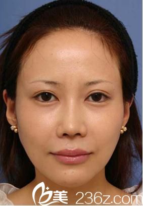 在日本美真美容的福田慶三醫(yī)生那里做了切開雙眼皮，我也有了明眸善睞