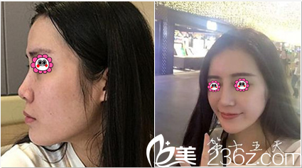 北京煤醫(yī)整形硅膠隆鼻