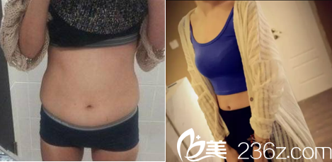 北京煤醫(yī)整形李艷腰腹吸脂