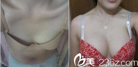 北京煤醫(yī)整形脂肪豐胸