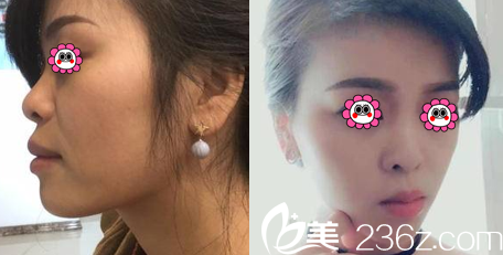 北京煤醫(yī)整形李敏面部輪廓塑形