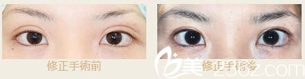 池本繁宏雙眼皮變窄修復(fù)