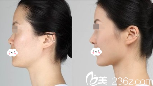 株洲希美假體隆鼻真人<span style=