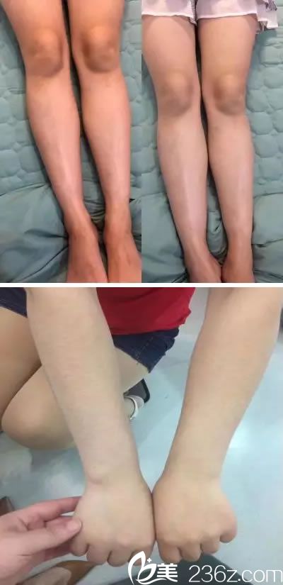 義烏張小紅美白艙真人案例效果