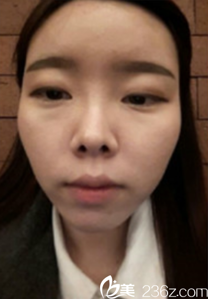 韓國新帝瑞娜面部輪廓+鼻修復手術術前 韓國新帝瑞娜面部輪廓+鼻修復手術術前