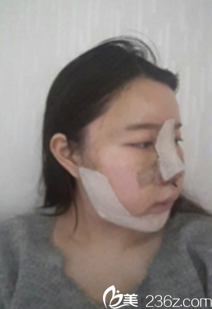 韓國新帝瑞娜面部輪廓+鼻修復手術術后第2天 韓國新帝瑞娜面部輪廓+鼻修復手術術后第2天