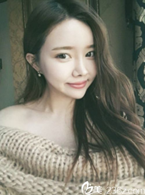 韓國新帝瑞娜面部輪廓+鼻修復手術術后第330天 韓國新帝瑞娜面部輪廓+鼻修復手術術后第330天