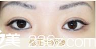 池本形成外科.美容外科池本繁醫(yī)生的高超雙眼皮修復(fù)前后對(duì)比，讓我目若秋波