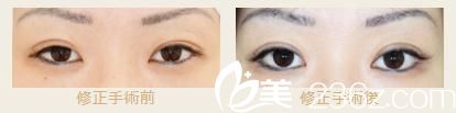 池本繁醫(yī)生的高超雙眼皮修復(fù)對(duì)比照片