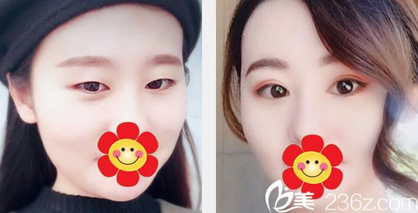 呼和浩特五洲全切雙眼皮+開內(nèi)眼角效果案例 呼和浩特五洲全切雙眼皮+開內(nèi)眼角效果案例