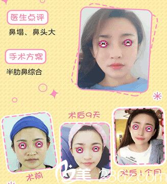 南通維多利亞鼻綜合效果圖