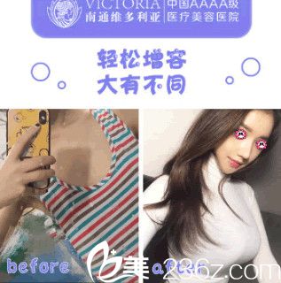 南通維多利亞沈正洲隆胸前后對(duì)比圖