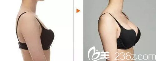 何琪胸部手術(shù)案例