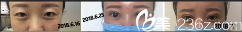 彭書強(qiáng)院長(zhǎng)雙眼皮手術(shù)案例