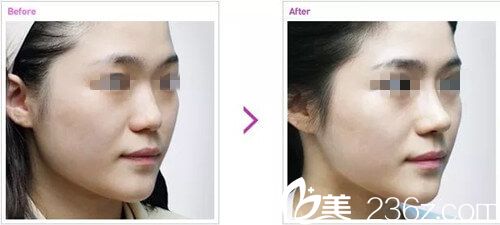 彭書強(qiáng)院長(zhǎng)鼻整形手術(shù)案例