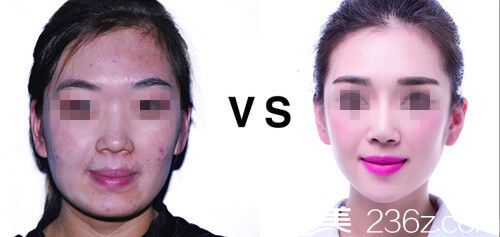 卓冬山主任激光祛痘手術(shù)案例