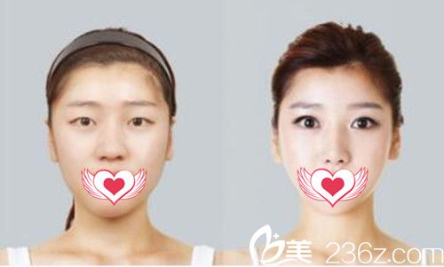 佛山華美割雙眼皮案例效果對比 佛山華美割雙眼皮案例效果對比