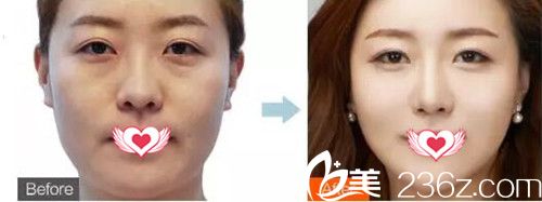 佛山華美整形除皺案例效果 佛山華美整形除皺案例效果