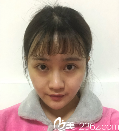 深圳非凡易培金全切雙眼皮7天拆線圖片 深圳非凡易培金全切雙眼皮7天拆線圖片