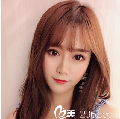 深圳非凡易培金做的雙眼皮案例15天照片 深圳非凡易培金做的雙眼皮案例15天照片