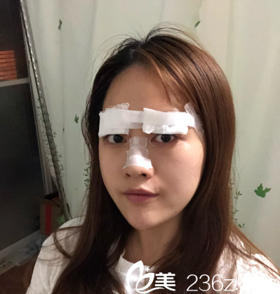 找易培金做完雙眼皮術(shù)后天 找易培金做完雙眼皮術(shù)后天