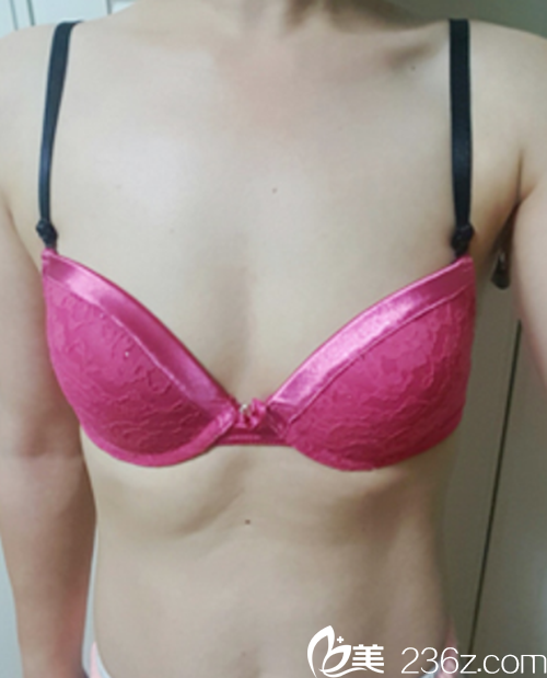 韓國(guó)麥恩醫(yī)院motiva假體隆胸手術(shù)術(shù)前