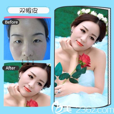 深圳非凡12月年終特惠整形價格表 丁鋒梅夠明雙眼皮隆鼻1680元附案例