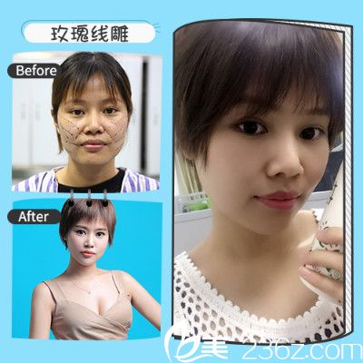 深圳非凡張佳佳做的面部線雕提升案例 深圳非凡張佳佳做的面部線雕提升案例