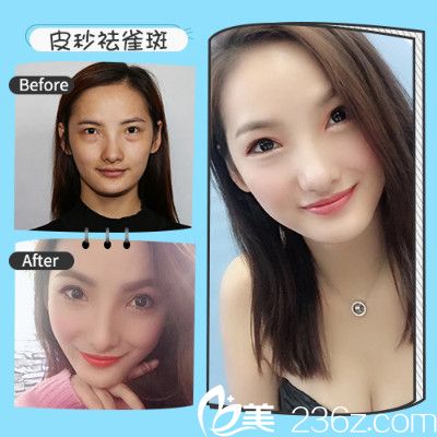 深圳非凡騰傳遠(yuǎn)做的超皮秒祛斑案例 深圳非凡騰傳遠(yuǎn)做的超皮秒祛斑案例