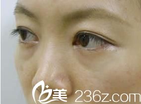 祛眼袋手術(shù)前側(cè)面展示
