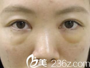 手術(shù)三天后