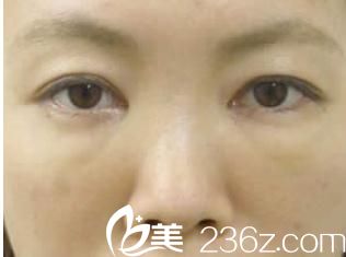 手術(shù)一周后