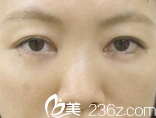 手術(shù)兩周后