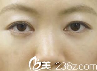 手術(shù)一個(gè)月