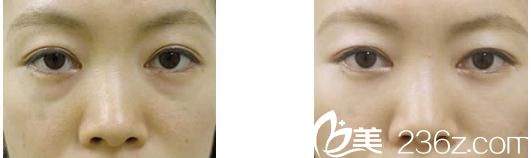 去眼袋手術(shù)前后對(duì)比