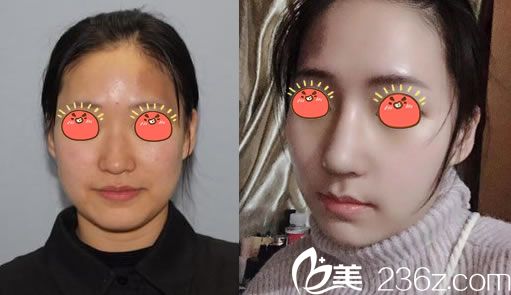 寧波薇琳張潮肋軟骨鼻綜合案例