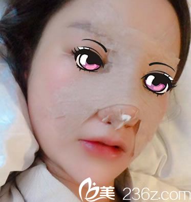 剛做完肋軟骨鼻綜合隆鼻照片 剛做完肋軟骨鼻綜合隆鼻照片