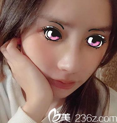 肋軟骨鼻綜合手術(shù)7天恢復(fù)照 肋軟骨鼻綜合手術(shù)7天恢復(fù)照