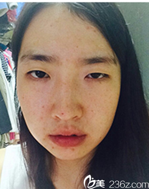 韓國新帝瑞娜醫(yī)院做眼部+鼻部+脂肪填充+v-line術前 韓國新帝瑞娜醫(yī)院做眼部+鼻部+脂肪填充+v-line術前