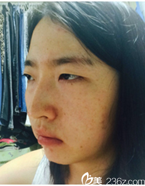 韓國新帝瑞娜醫(yī)院做眼部+鼻部+脂肪填充+v-line術前 韓國新帝瑞娜醫(yī)院做眼部+鼻部+脂肪填充+v-line術前