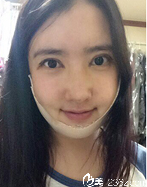 韓國新帝瑞娜醫(yī)院做眼部+鼻部+脂肪填充+v-line術后一周后 韓國新帝瑞娜醫(yī)院做眼部+鼻部+脂肪填充+v-line術后一周后