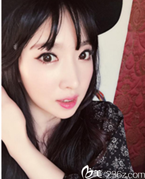 韓國新帝瑞娜醫(yī)院做眼部+鼻部+脂肪填充+v-line術后1個月后 韓國新帝瑞娜醫(yī)院做眼部+鼻部+脂肪填充+v-line術后1個月后