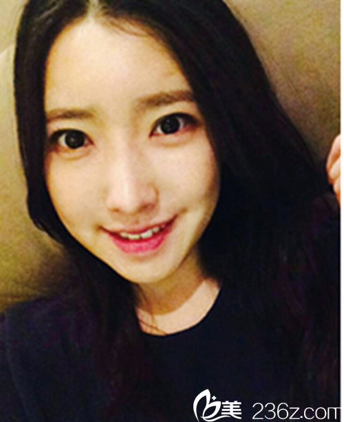 韓國新帝瑞娜醫(yī)院做眼部+鼻部+脂肪填充+v-line術后1個月后 韓國新帝瑞娜醫(yī)院做眼部+鼻部+脂肪填充+v-line術后1個月后