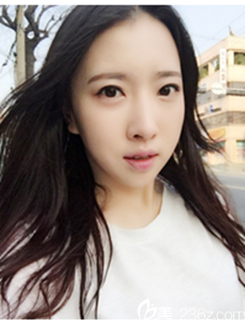 韓國新帝瑞娜醫(yī)院做眼部+鼻部+脂肪填充+v-line術后6個月后 韓國新帝瑞娜醫(yī)院做眼部+鼻部+脂肪填充+v-line術后6個月后