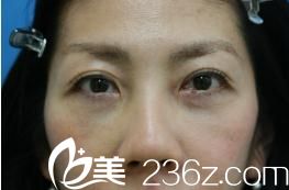 手術(shù)7日后 手術(shù)7日后