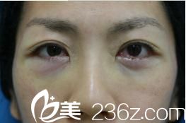 手術(shù)結(jié)束當(dāng)天 手術(shù)結(jié)束當(dāng)天