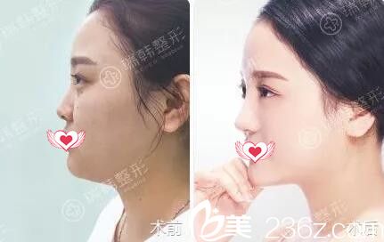 趙雙慶鼻部整形真人前后效果對(duì)比