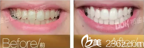 重慶銅雀臺潔牙案例